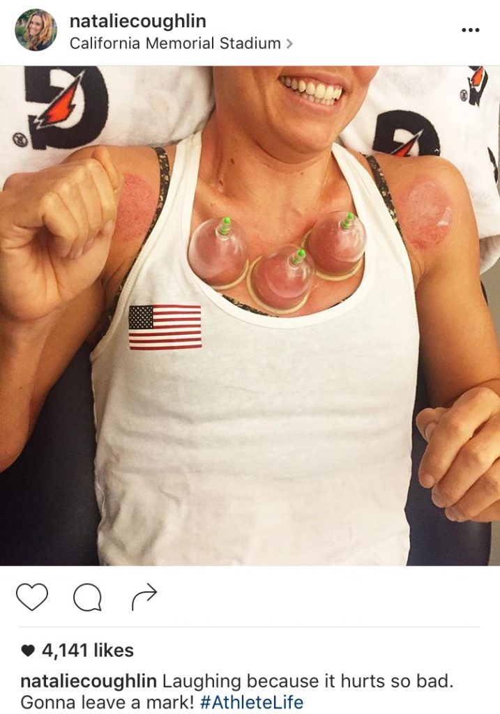 American swimmer Natalie Coughlin posted a picture of herself undergoing treatment